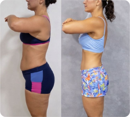 Antes e Depois Mulher 5